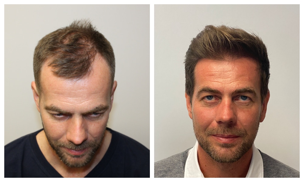 Hair Transplant Tips